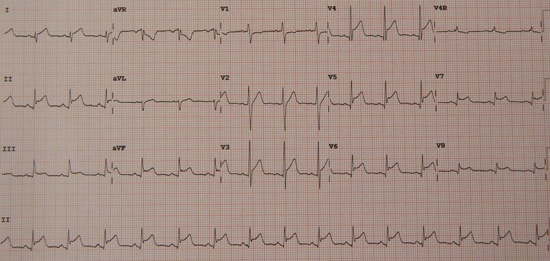 ECG dans les troubles métaboliques (kalémie, péricardite)