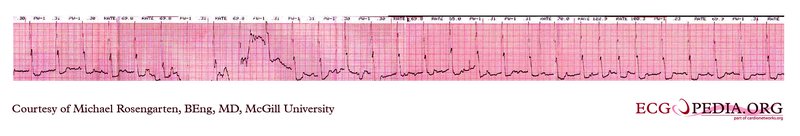 Holter-ECG et méthodes ECG ambulatoires