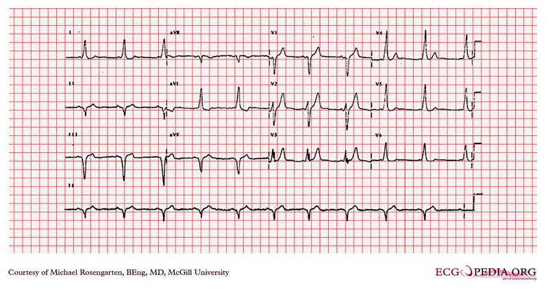 Holter-ECG et méthodes ECG ambulatoires