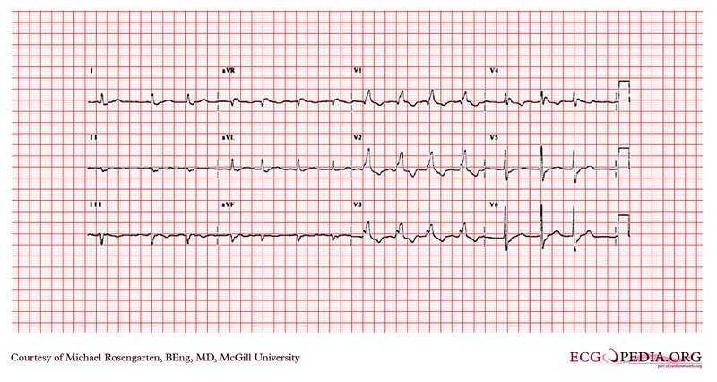 Holter-ECG et méthodes ECG ambulatoires
