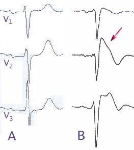 Syndrome de Brugada