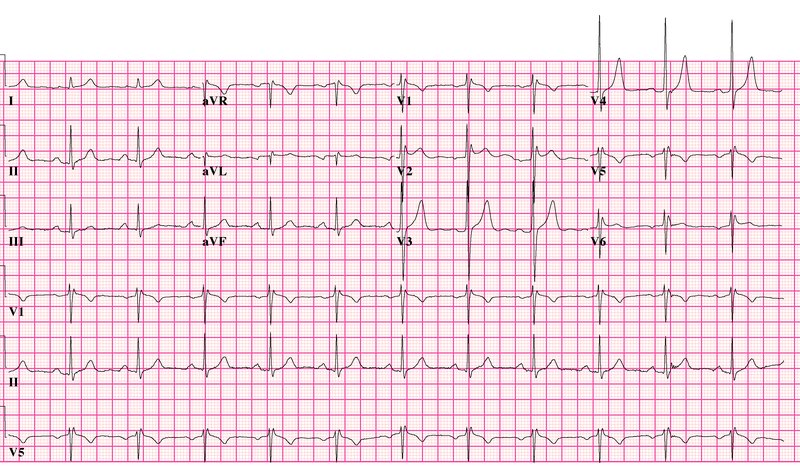 Syndrome de Brugada