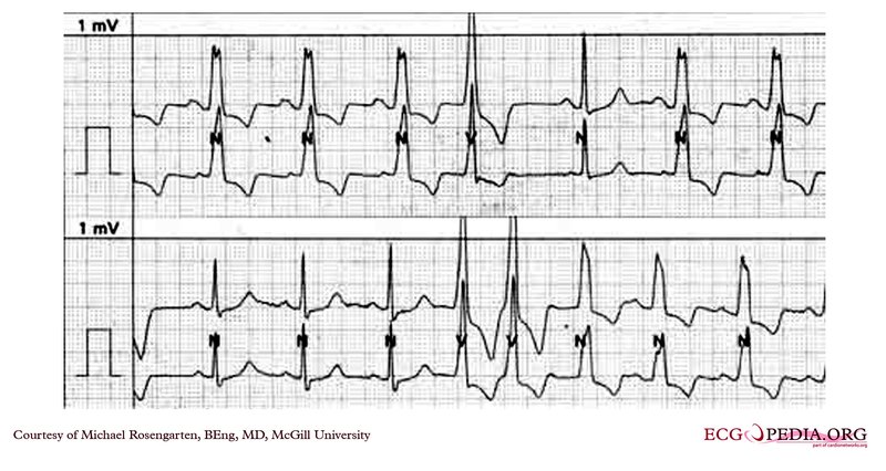 Syndrome de Brugada