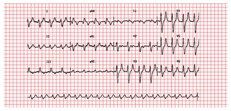 Diagnostic de la FA (ECG, bilan)