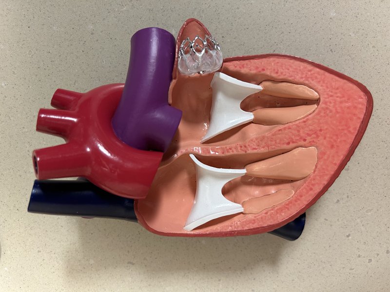 Traitement antithrombotique FA (AOD, AVK)