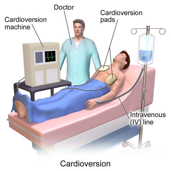 Cardioversion électrique externe (CEE)