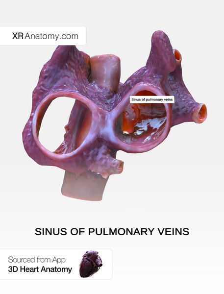 Ablation par cathéter (isolation des veines pulmonaires)
