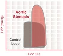 Rétrécissement aortique : étiologies