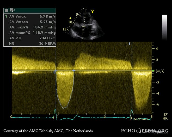 RA : diagnostic, ETT, critères de sévérité