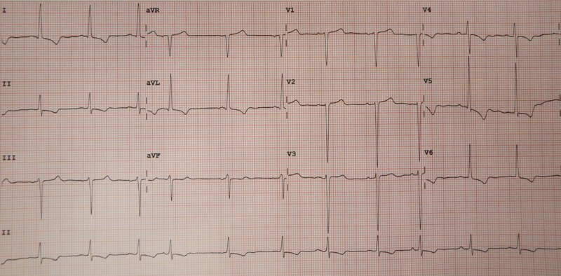 RA : diagnostic, ETT, critères de sévérité