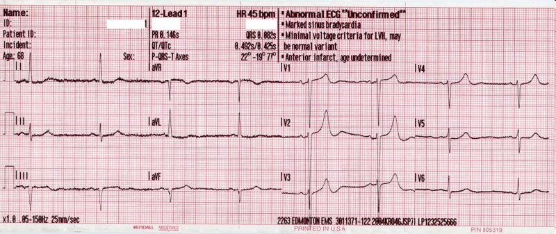 RA : diagnostic, ETT, critères de sévérité