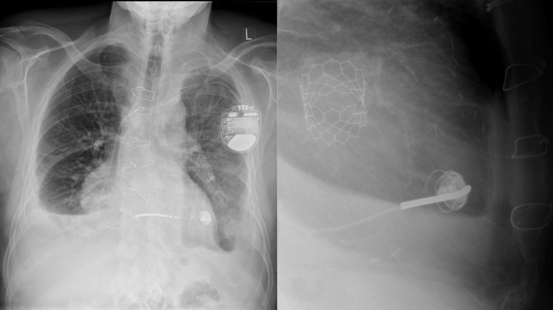 RA : traitement (chirurgie valvulaire, TAVI)