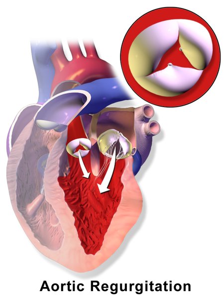 Insuffisance aortique : étiologies et diagnostic