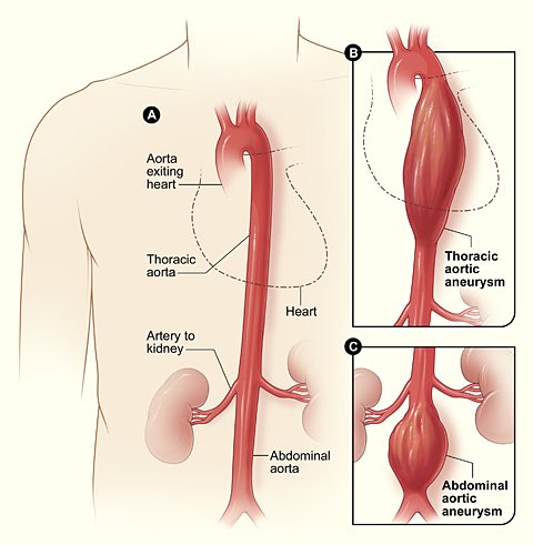 Insuffisance aortique : étiologies et diagnostic