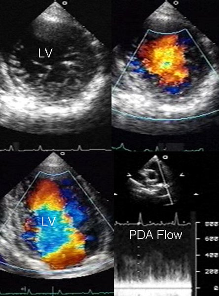 Diagnostic IC gauche : dyspnée et classification NYHA