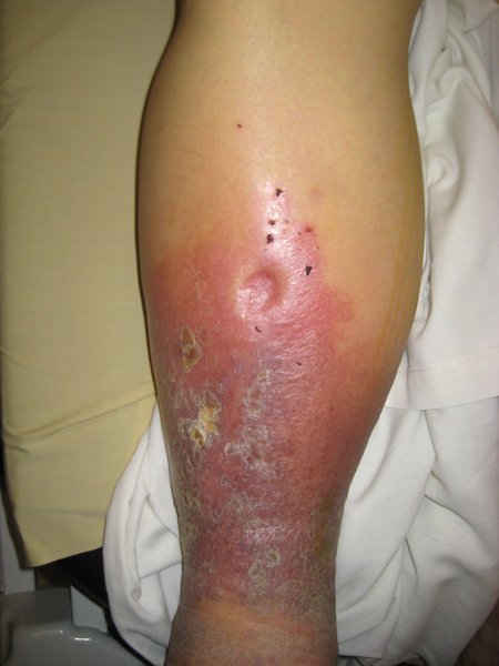 Diagnostic IC gauche : dyspnée et classification NYHA