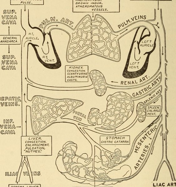 Diagnostic IC droite (œdèmes, TJ, ascite)