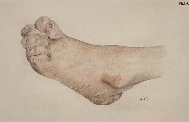 Diagnostic IC droite (œdèmes, TJ, ascite)