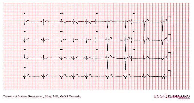 IC à fraction d'éjection préservée (HFpEF)