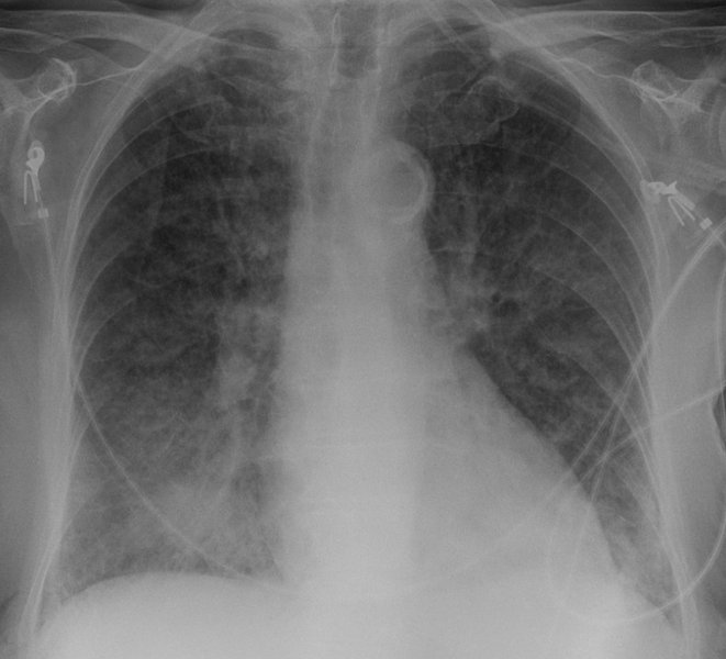 IC à fraction d'éjection préservée (HFpEF)