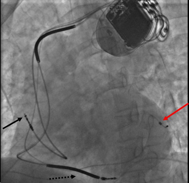 Traitement médicamenteux de l'IC systolique (FEVG réduite)