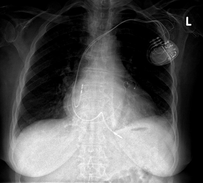 Resynchronisation ventriculaire (CRT)