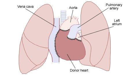 Transplantation cardiaque