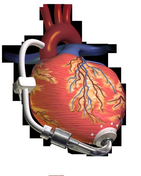 Transplantation cardiaque