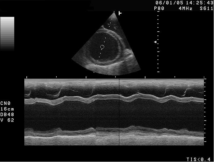 Cardiomyopathie dilatée (CMD)