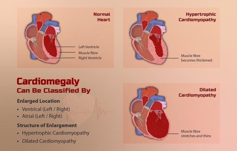 Cardiomyopathie dilatée (CMD)