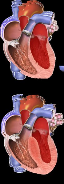 Cardiomyopathie hypertrophique (CMH)