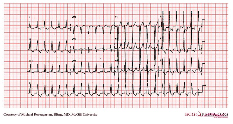 Cardiomyopathie hypertrophique (CMH)