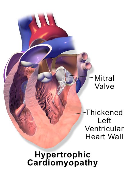 Cardiomyopathie hypertrophique (CMH)
