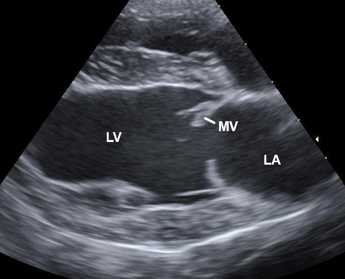 Cardiomyopathie restrictive