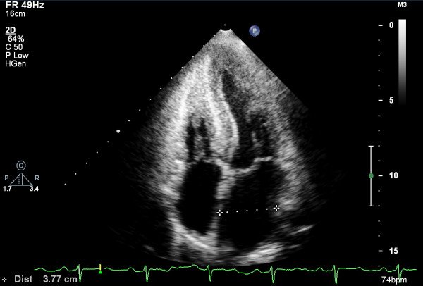 Cardiomyopathie restrictive