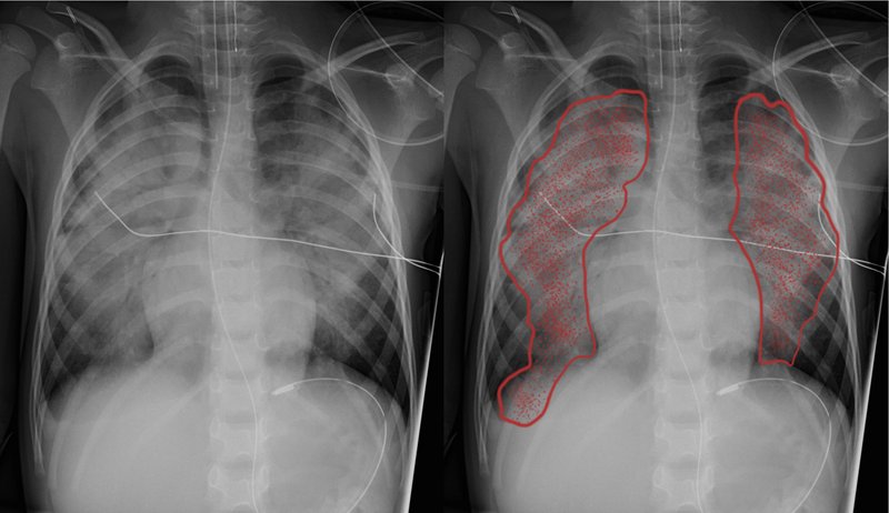 Diagnostic de l'OAP (signes cliniques, RP, GDS)