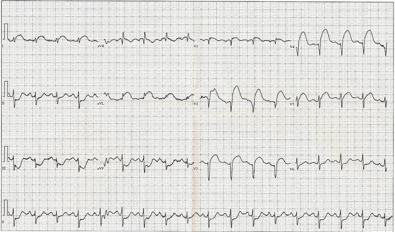 Choc cardiogénique