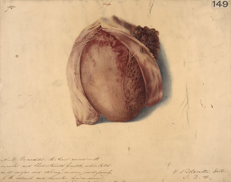 Diagnostic de la péricardite aiguë