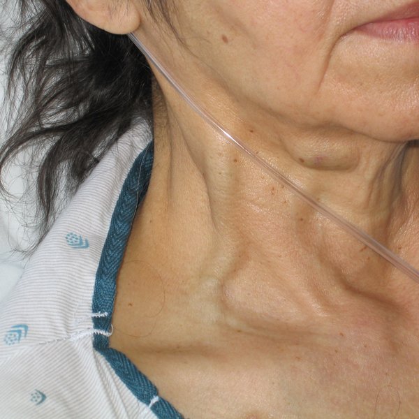 Diagnostic de la péricardite aiguë