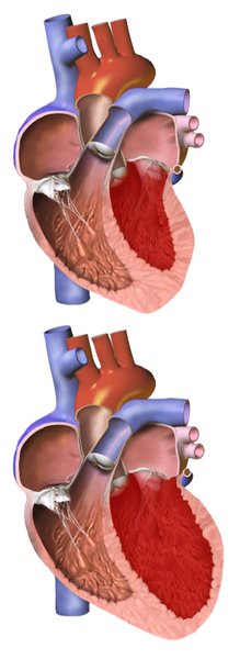 Diagnostic de la péricardite aiguë