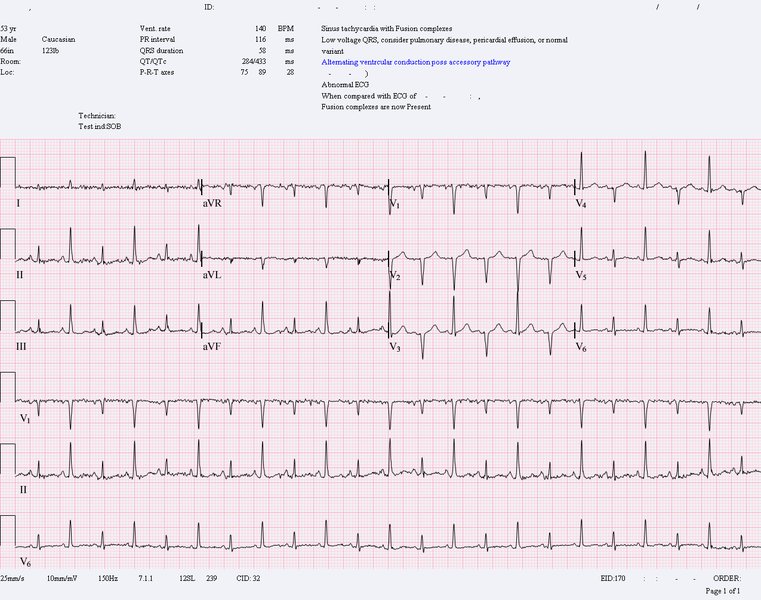 Tamponnade cardiaque