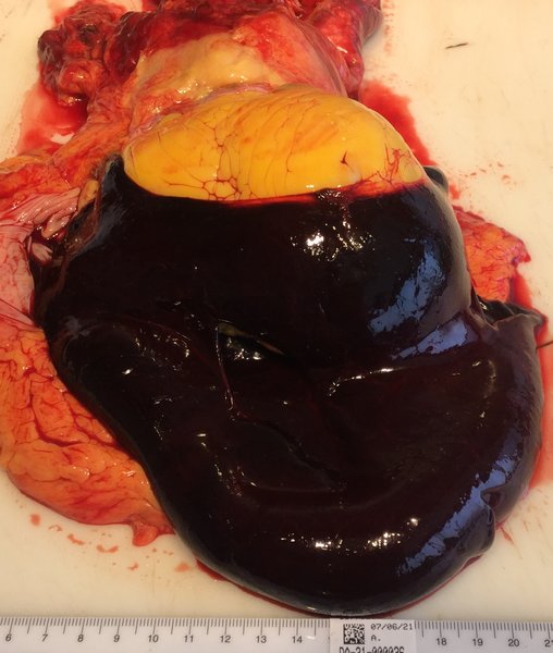 Tamponnade cardiaque