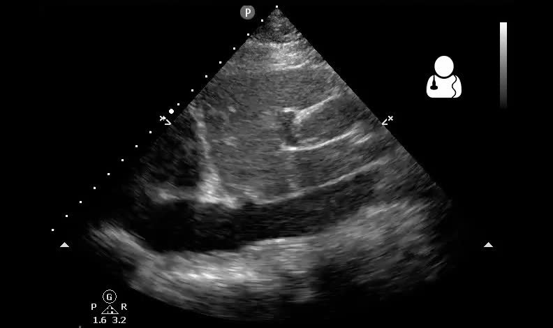 Tamponnade cardiaque
