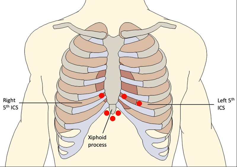 Tamponnade cardiaque