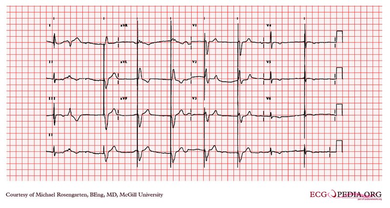 Stimulateur cardiaque (pacemaker) : types, pose, suivi