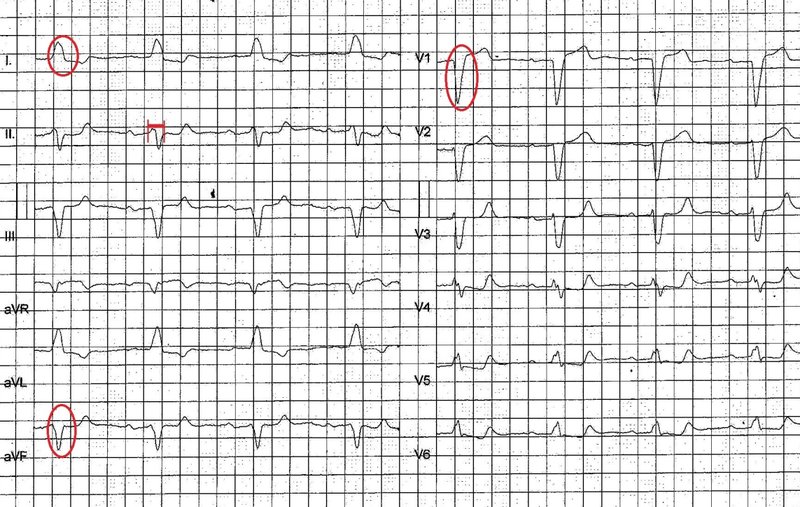 Stimulateur cardiaque (pacemaker) : types, pose, suivi