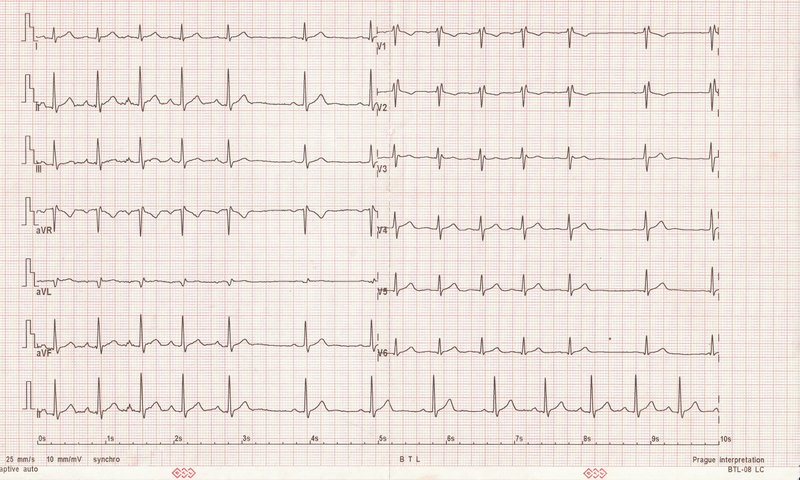 Stimulateur cardiaque (pacemaker) : types, pose, suivi