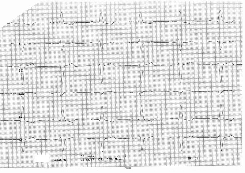 Stimulateur cardiaque (pacemaker) : types, pose, suivi