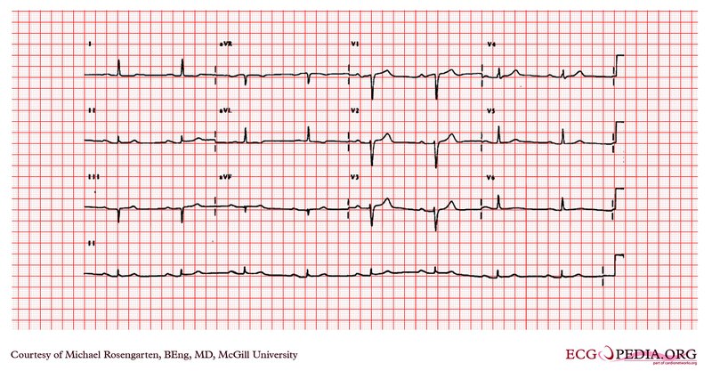 Stimulateur cardiaque (pacemaker) : types, pose, suivi