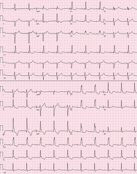 Stimulateur cardiaque (pacemaker) : types, pose, suivi